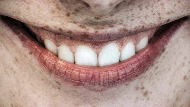 darse canto dientes learn spanish