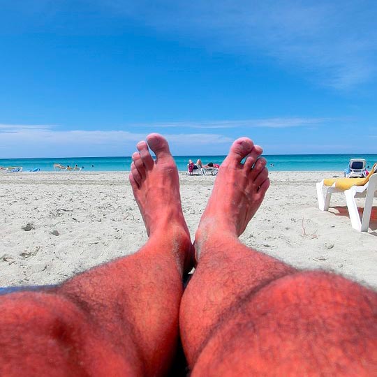 Learn Spanish sunburn quemadura